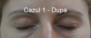 Corectie Pleoape - Dupa